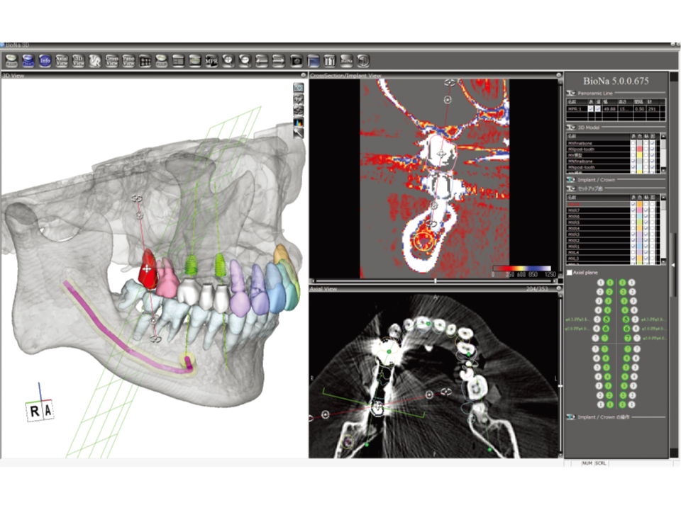 BioNa シミュレーションソフトウェアの画面 ― 3D顎骨モデル上でインプラント埋入位置をプランニングしている様子